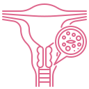 Cervix Cancer